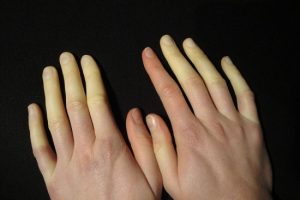 Why Are My Hands Turning Yellow?